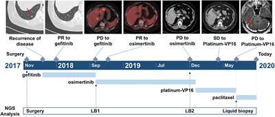Small Cell Lung Cancer Transformation as a Resistance Mechanism to Osimertinib in Epidermal Growth Factor Receptor-Mutated Lung Adenocarcinoma: Case Report and Literature Review